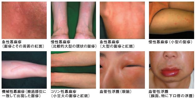 蕁麻疹 じんましん たかはし皮膚科クリニック 苫小牧市の皮膚科医院