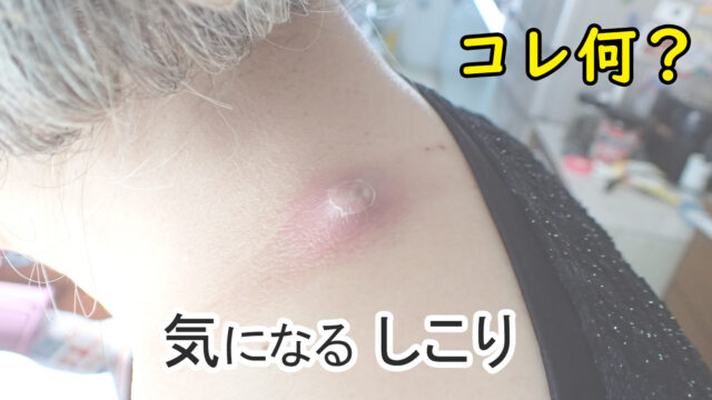 皮膚のしこり - 健康百科事典