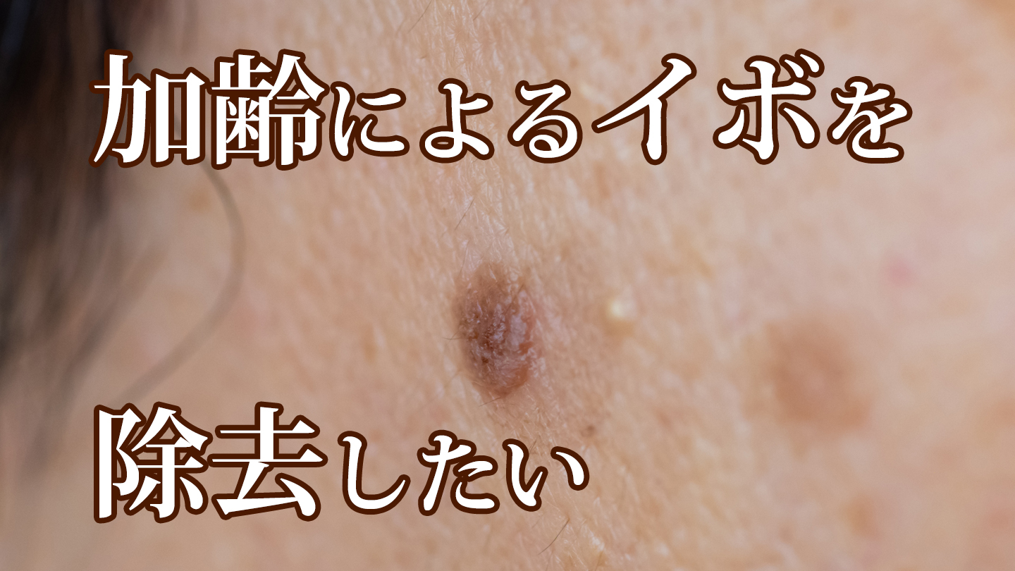 加齢によるイボ【脂漏性角化腫】｜たかはし皮膚科