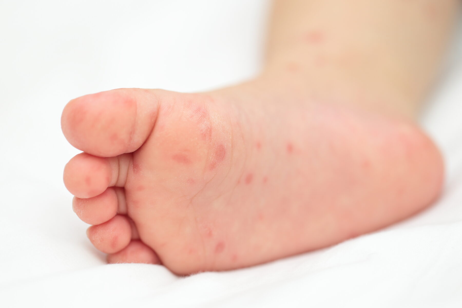 なぜ手足口病のために隔離する必要があるのですか?